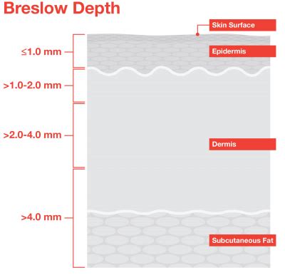 how to measure breslow thickness|breslow thickness 0.5 mm.